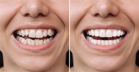 composite teeth veneers|Everything You Need To Know About C.